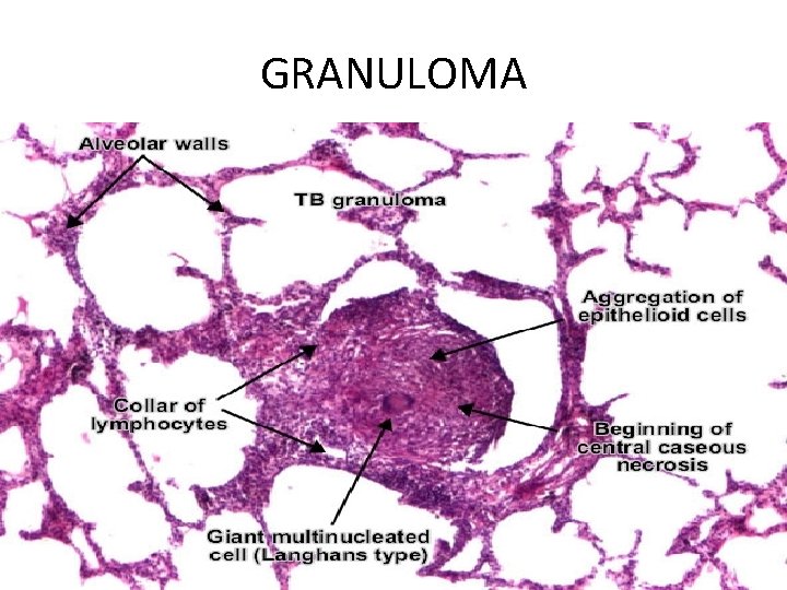 GRANULOMA 