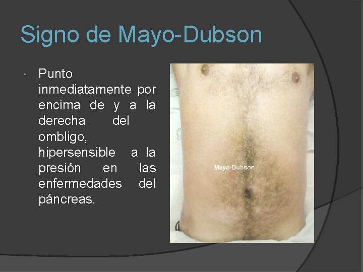 Signo de Mayo-Dubson Punto inmediatamente por encima de y a la derecha del ombligo,