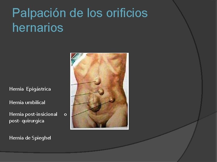 Palpación de los orificios hernarios Hernia Epigástrica Hernia umbilical Hernia post-insicional post- quirurgica Hernia