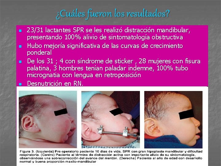 ¿Cuáles fueron los resultados? n n 23/31 lactantes SPR se les realizó distracción mandibular,