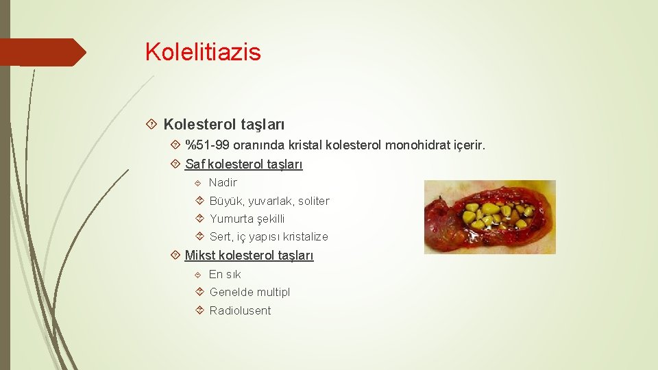 Kolelitiazis Kolesterol taşları %51 -99 oranında kristal kolesterol monohidrat içerir. Saf kolesterol taşları Nadir