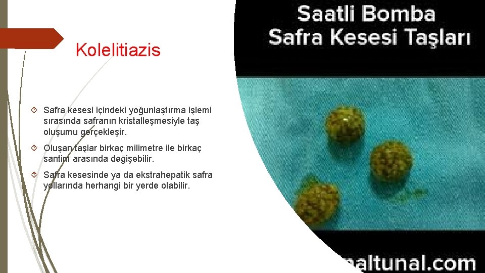  Kolelitiazis Safra kesesi içindeki yoğunlaştırma işlemi sırasında safranın kristalleşmesiyle taş oluşumu gerçekleşir. Oluşan