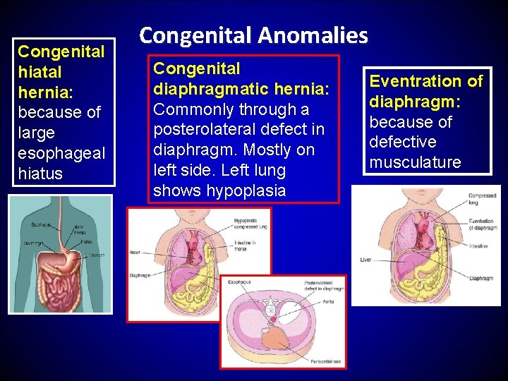 Congenital hiatal hernia: because of large esophageal hiatus Congenital Anomalies Congenital diaphragmatic hernia: Commonly