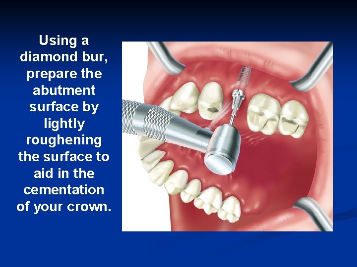 Using a diamond bur, prepare the abutment surface by lightly roughening the surface to