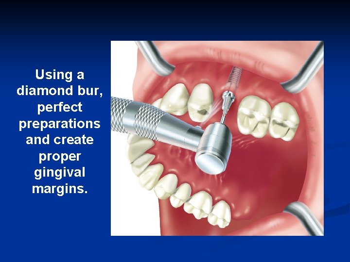 Using a diamond bur, perfect preparations and create proper gingival margins. 