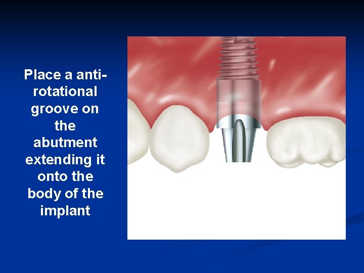 Place a antirotational groove on the abutment extending it onto the body of the