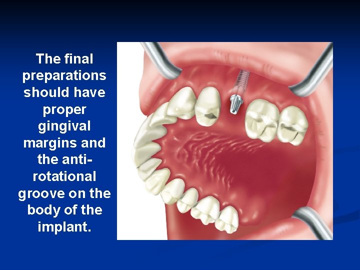 The final preparations should have proper gingival margins and the antirotational groove on the