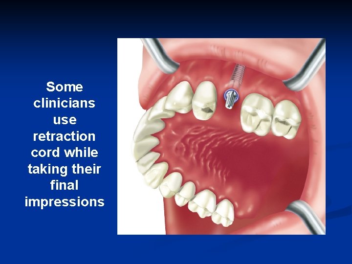 Some clinicians use retraction cord while taking their final impressions 