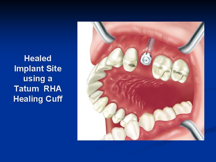 Healed Implant Site using a Tatum RHA Healing Cuff 