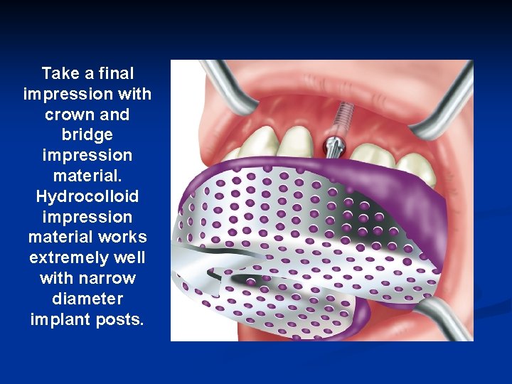 Take a final impression with crown and bridge impression material. Hydrocolloid impression material works