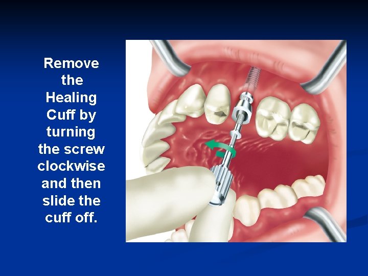 Remove the Healing Cuff by turning the screw clockwise and then slide the cuff