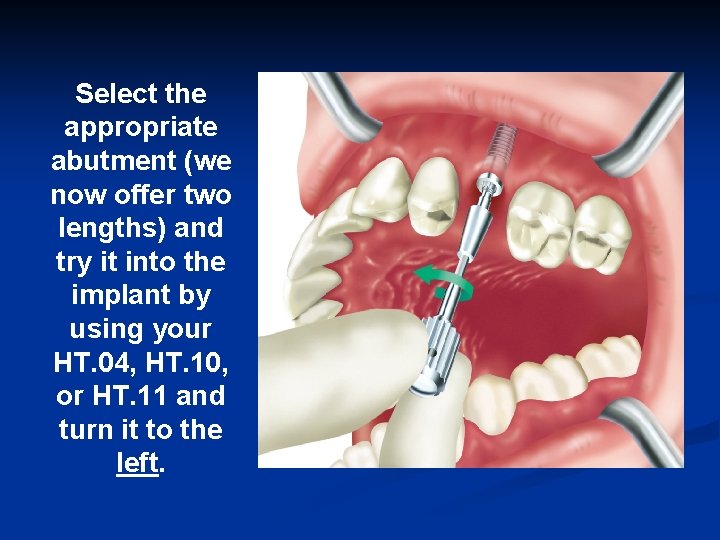 Select the appropriate abutment (we now offer two lengths) and try it into the