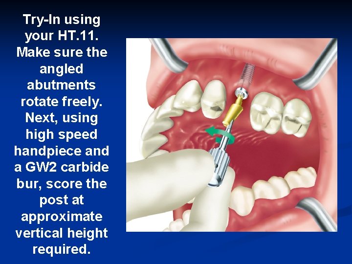Try-In using your HT. 11. Make sure the angled abutments rotate freely. Next, using
