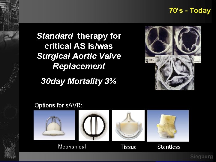 70’s - Today Standard therapy for critical AS is/was Surgical Aortic Valve Replacement 30