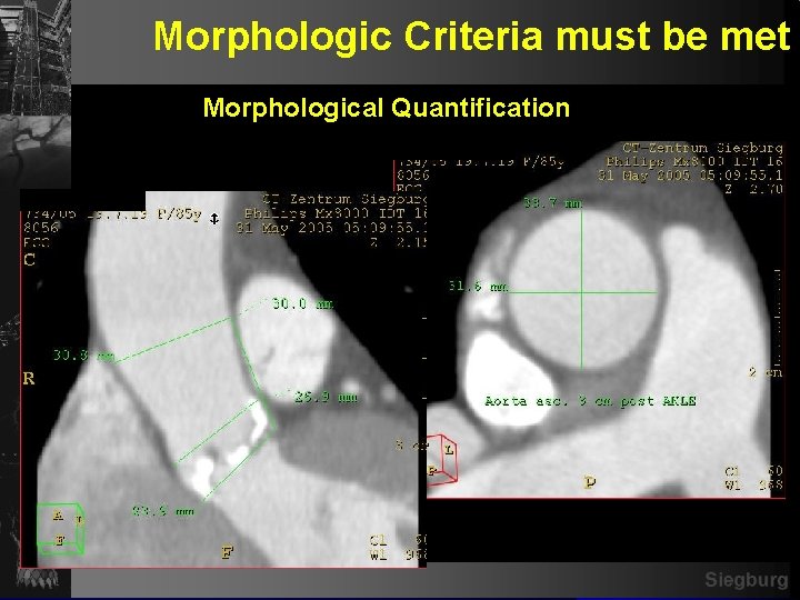 Morphologic Criteria must be met Morphological Quantification Siegburg 