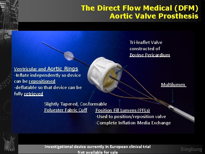 The Direct Flow Medical (DFM) Aortic Valve Prosthesis Tri-leaflet Valve constructed of Bovine Pericardium