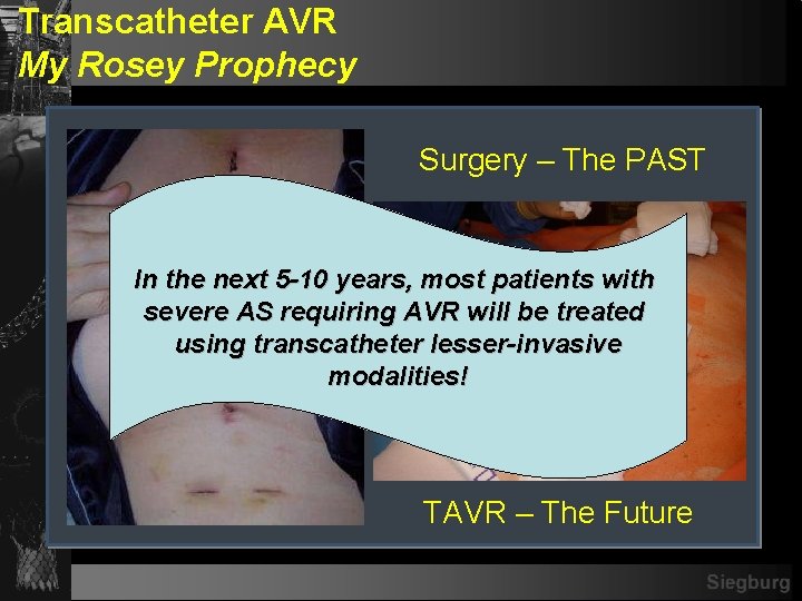 Transcatheter AVR My Rosey Prophecy Surgery – The PAST In the next 5 -10