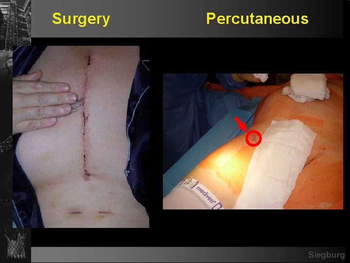 Surgery Percutaneous 