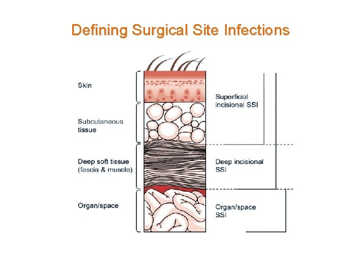 Defining Surgical Site Infections 