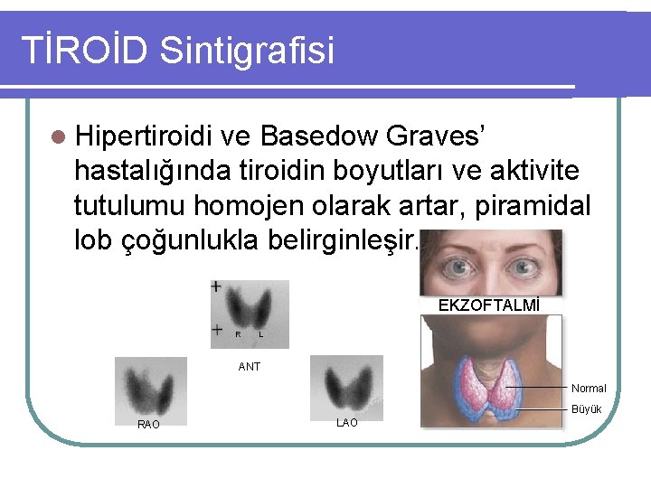 TİROİD Sintigrafisi l Hipertiroidi ve Basedow Graves’ hastalığında tiroidin boyutları ve aktivite tutulumu homojen