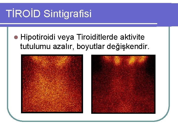 TİROİD Sintigrafisi l Hipotiroidi veya Tiroiditlerde aktivite tutulumu azalır, boyutlar değişkendir. 