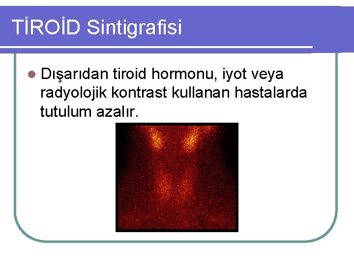 TİROİD Sintigrafisi l Dışarıdan tiroid hormonu, iyot veya radyolojik kontrast kullanan hastalarda tutulum azalır.