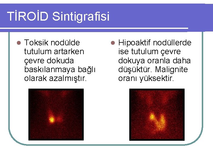 TİROİD Sintigrafisi l Toksik nodülde tutulum artarken çevre dokuda baskılanmaya bağlı olarak azalmıştır. l