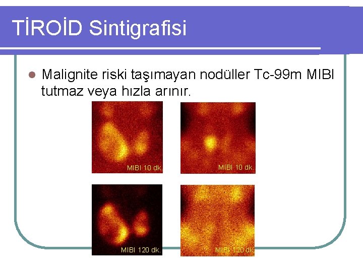 TİROİD Sintigrafisi l Malignite riski taşımayan nodüller Tc-99 m MIBI tutmaz veya hızla arınır.