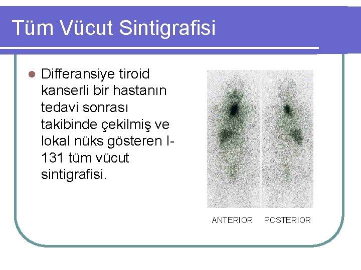 Tüm Vücut Sintigrafisi l Differansiye tiroid kanserli bir hastanın tedavi sonrası takibinde çekilmiş ve