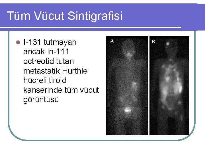 Tüm Vücut Sintigrafisi l I-131 tutmayan ancak In-111 octreotid tutan metastatik Hurthle hücreli tiroid