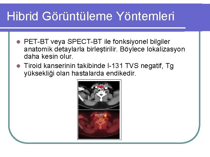 Hibrid Görüntüleme Yöntemleri PET-BT veya SPECT-BT ile fonksiyonel bilgiler anatomik detaylarla birleştirilir. Böylece lokalizasyon