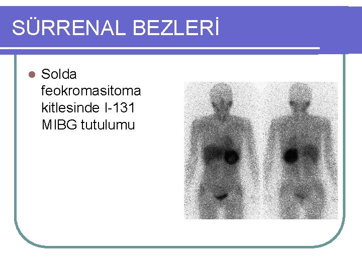 SÜRRENAL BEZLERİ l Solda feokromasitoma kitlesinde I-131 MIBG tutulumu 