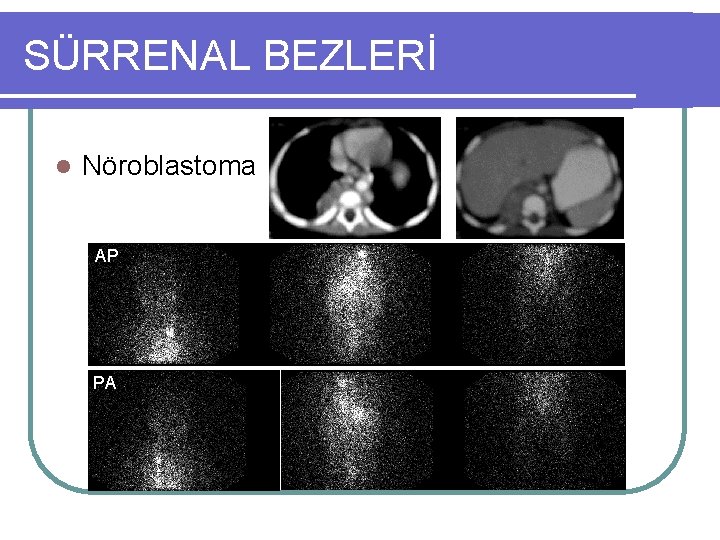 SÜRRENAL BEZLERİ l Nöroblastoma AP PA 