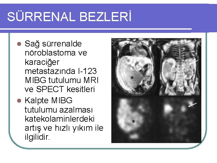 SÜRRENAL BEZLERİ Sağ sürrenalde nöroblastoma ve karaciğer metastazında I-123 MIBG tutulumu MRI ve SPECT