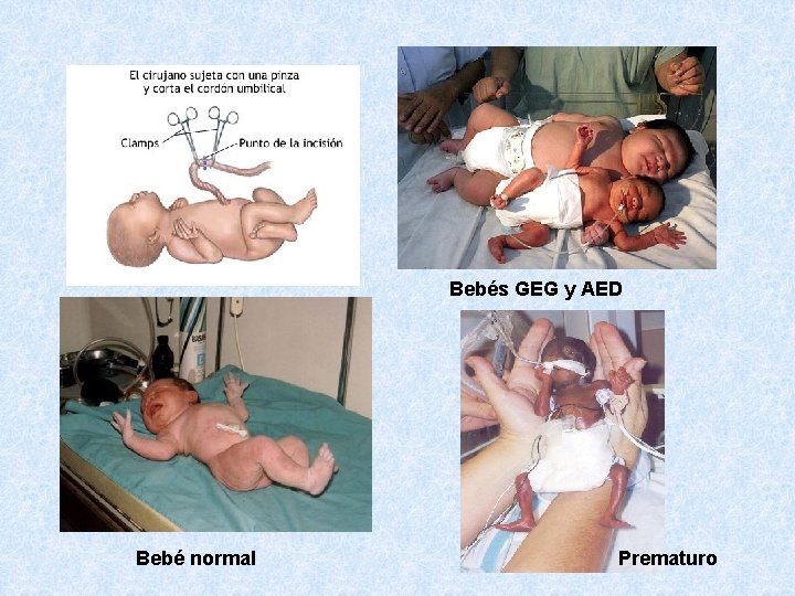 Bebés GEG y AED Bebé normal Prematuro 