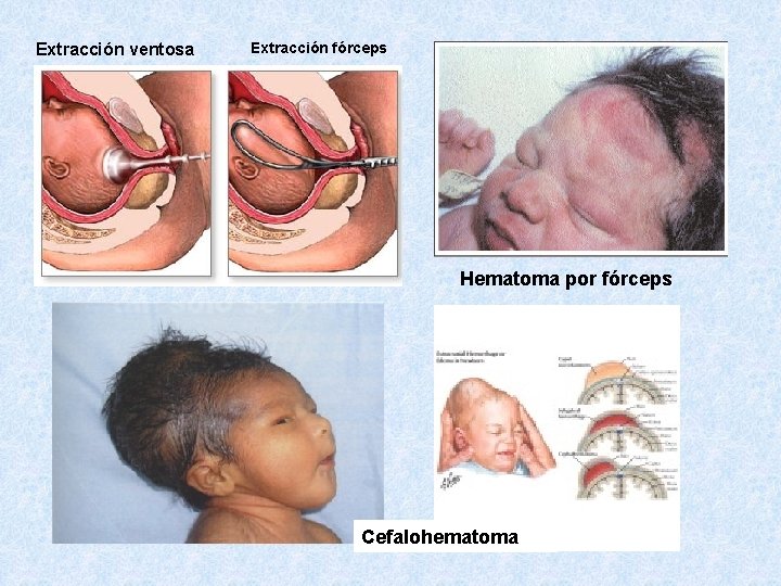 Extracción ventosa Extracción fórceps Hematoma por fórceps Cefalohematoma 