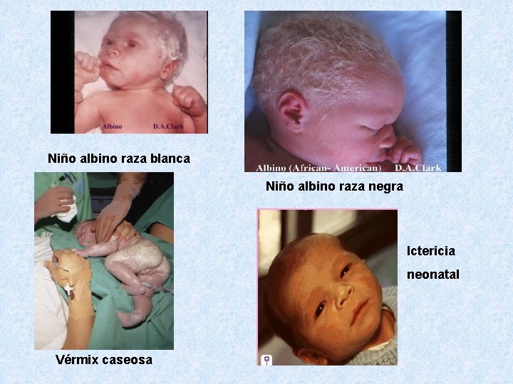Niño albino raza blanca Niño albino raza negra Ictericia neonatal Vérmix caseosa 