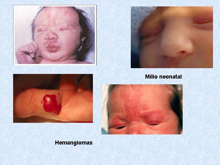 Milio neonatal Hemangiomas 