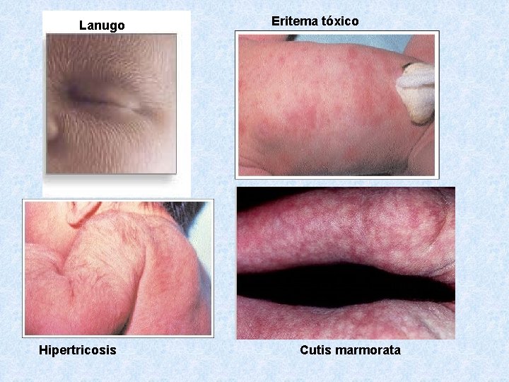 Lanugo Hipertricosis Eritema tóxico Cutis marmorata 