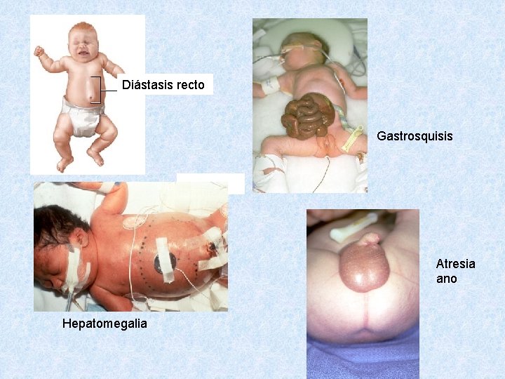 Diástasis recto Gastrosquisis Atresia ano Hepatomegalia 