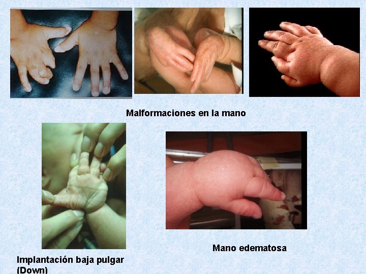 Malformaciones en la mano Mano edematosa Implantación baja pulgar (Down) 