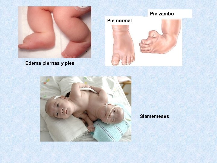 Pie zambo Pie normal Edema piernas y pies Siamemeses 