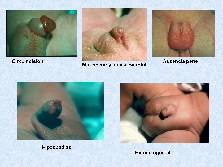 Circumcisión Hipospadias Micropene y fisura escrotal Ausencia pene Hernia Inguinal 