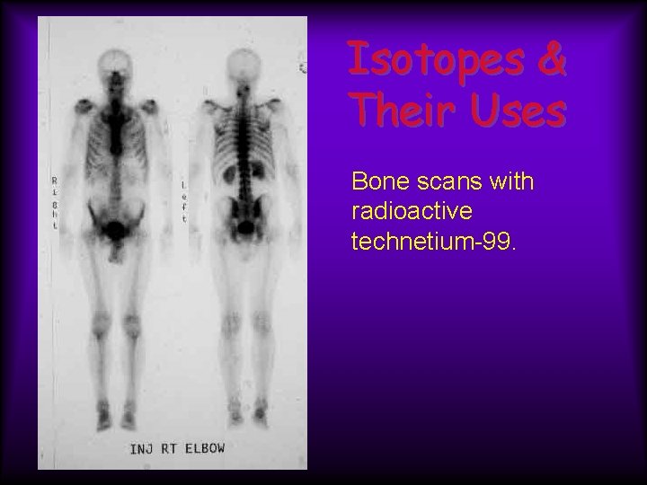 Isotopes & Their Uses Bone scans with radioactive technetium-99. 