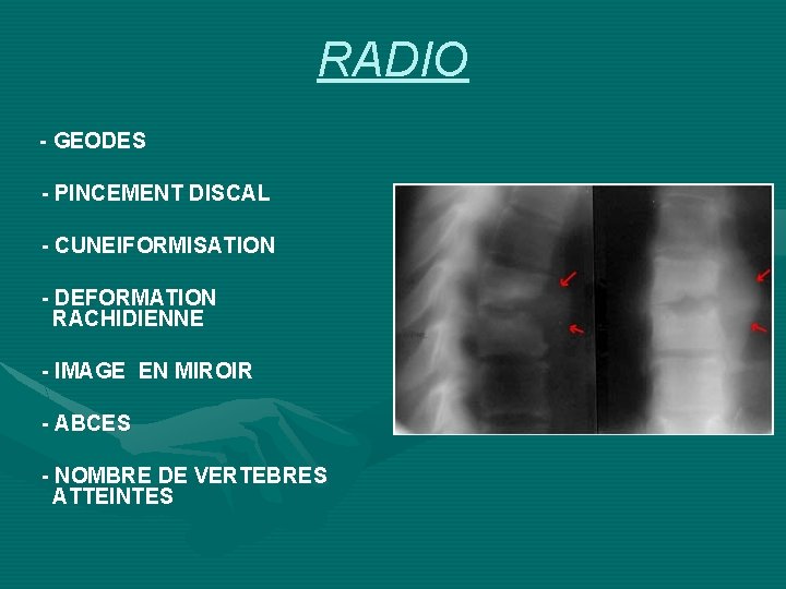 RADIO - GEODES - PINCEMENT DISCAL - CUNEIFORMISATION - DEFORMATION RACHIDIENNE - IMAGE EN