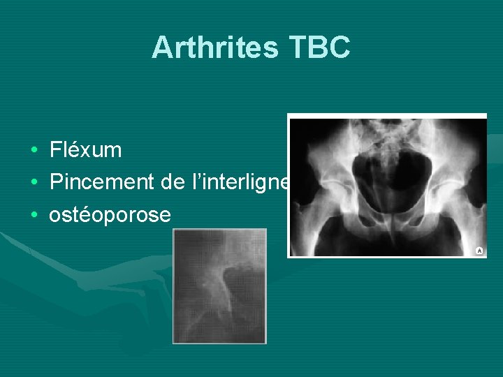 Arthrites TBC • • • Fléxum Pincement de l’interligne ostéoporose 
