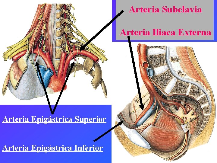 Arteria Subclavia Arteria Iliaca Externa Arteria Epigástrica Superior Arteria Epigástrica Inferior 