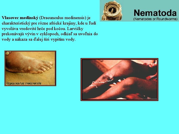 Vlasovec medinský (Dracunculus medinensis) je charakteristický pre rôzne africké krajiny, kde u ľudí vyvoláva