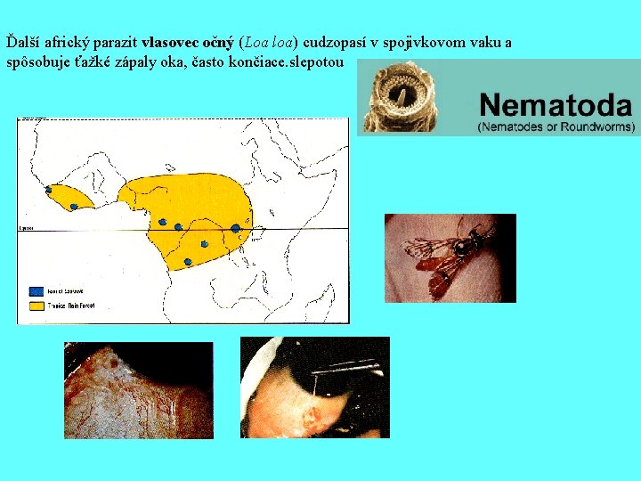Ďalší africký parazit vlasovec očný (Loa loa) cudzopasí v spojivkovom vaku a spôsobuje ťažké