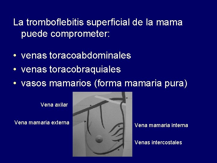 La tromboflebitis superficial de la mama puede comprometer: • venas toracoabdominales • venas toracobraquiales
